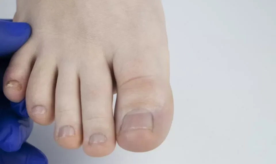 El ‘síntoma’ en su dedo meñique que podría estar alertando sobre un problema de salud