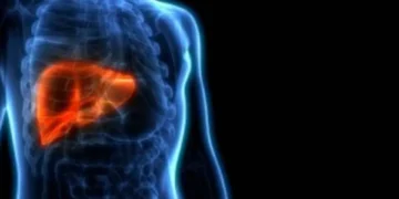 ¿Cuál es el tratamiento idóneo para el hígado graso?