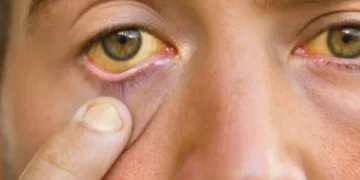 Atención con el hígado graso: ¿la piel puede revelar síntomas de esta enfermedad?