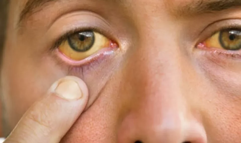 Atención con el hígado graso: ¿la piel puede revelar síntomas de esta enfermedad?