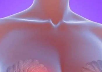 ¿Cuáles son los síntomas del cáncer de mama?