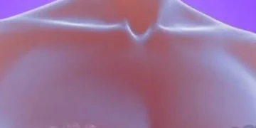 ¿Cuáles son los síntomas del cáncer de mama?