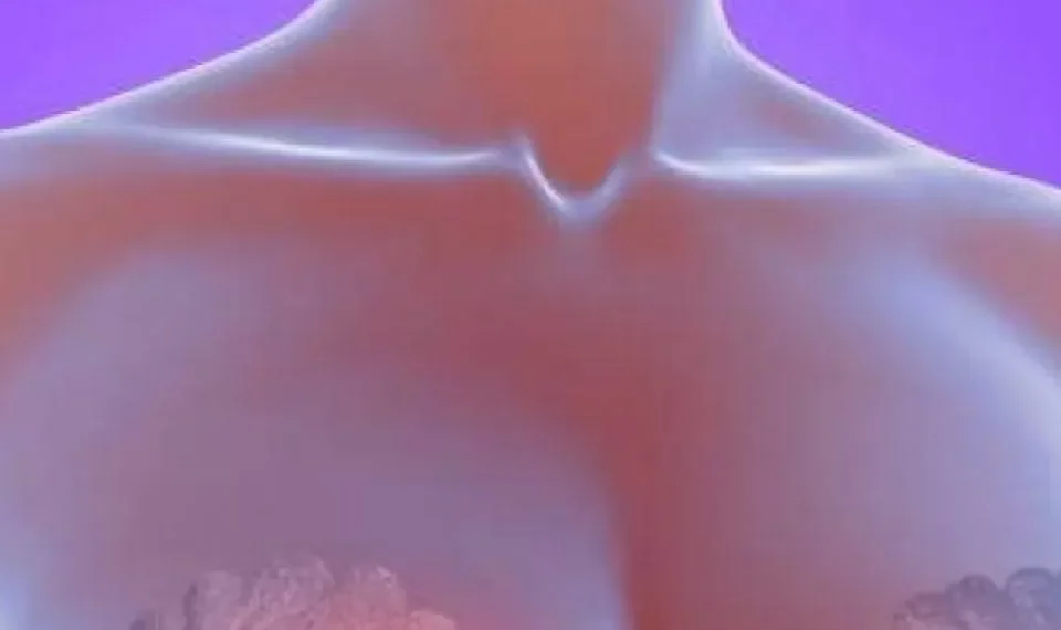 ¿Cuáles son los síntomas del cáncer de mama?