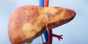 Esté alerta: ¿cuáles son los síntomas para identificar el hígado graso?