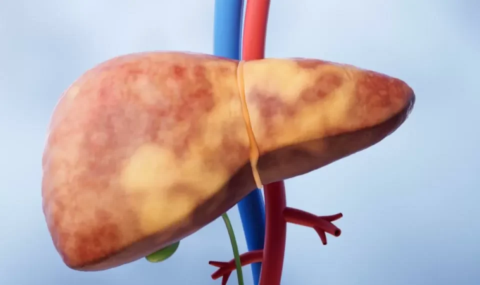 Esté alerta: ¿cuáles son los síntomas para identificar el hígado graso?