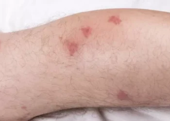 ¿Cuál es el órgano que afecta el mal de Chagas? Así le daña esta enfermedad