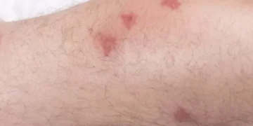 ¿Cuál es el órgano que afecta el mal de Chagas? Así le daña esta enfermedad