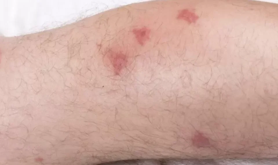 ¿Cuál es el órgano que afecta el mal de Chagas? Así le daña esta enfermedad