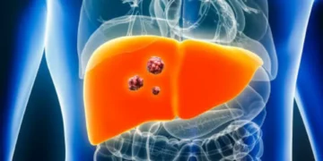 El examen que permite identificar el cáncer de hígado antes de que aparezcan síntomas