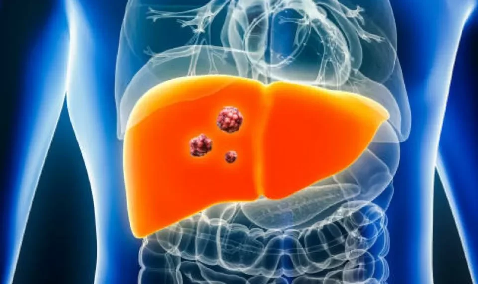 El examen que permite identificar el cáncer de hígado antes de que aparezcan síntomas