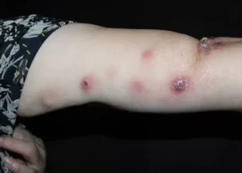 Santa Catarina promove capacitação inédita sobre esporotricose para profissionais de saúde e meio ambiente