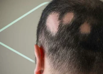 La alopecia areata: ¿qué la produce y cómo puede prevenirla?