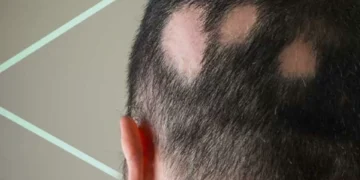 La alopecia areata: ¿qué la produce y cómo puede prevenirla?
