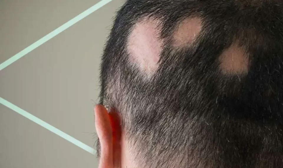 La alopecia areata: ¿qué la produce y cómo puede prevenirla?