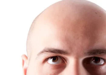 La calvicie no siempre es genética: estos son los motivos más comunes, según expertos