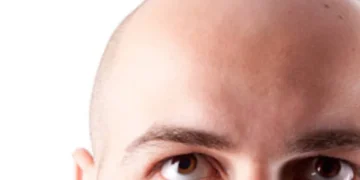 La calvicie no siempre es genética: estos son los motivos más comunes, según expertos