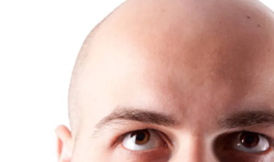 La calvicie no siempre es genética: estos son los motivos más comunes, según expertos