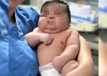 Parto normal de bebê de 6,5 kg vira alvo de investigação; mãe levou 55 pontos