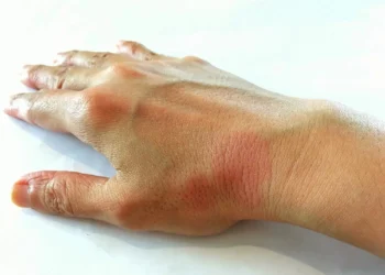 Vírus comum pode ser a chave do lúpus, dizem cientistas