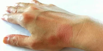 Vírus comum pode ser a chave do lúpus, dizem cientistas